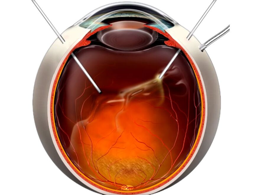 Vitrektomi - retina pul pul dökülme olduğunda insanlara gösterilen bir prosedür